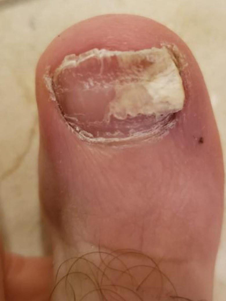 Before view of a customer's nail-care progression